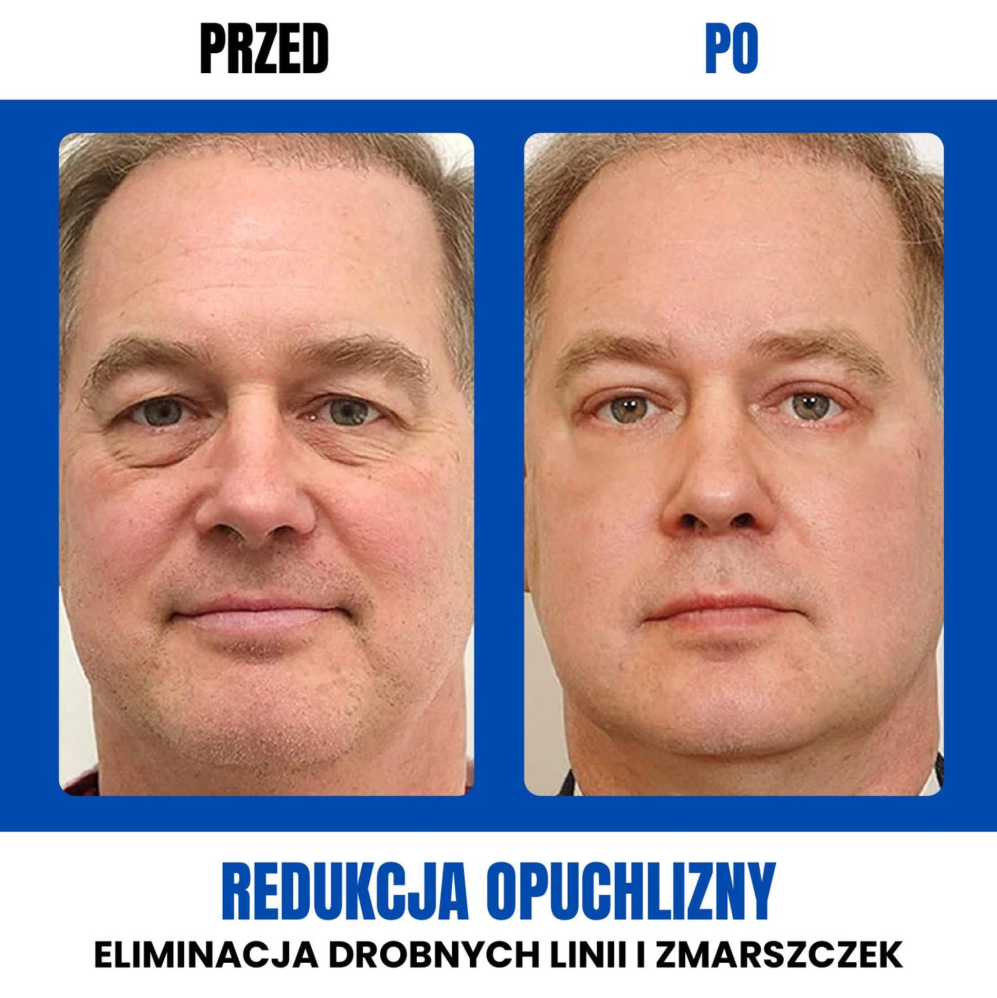 Krem Przeciw Cieniom Pod Oczami Z Przeciwstarzeniowym Retinolem - Openeyes